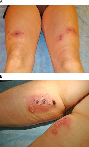 Caso 1: A) Nódulos eritematovioláceos en los muslos. B) Abscesificación y ulceración de los citados nódulos subcutáneos.