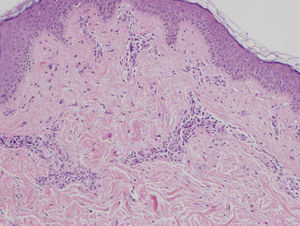 Telangiectasias en la dermis superficial, rodeadas de un infiltrado inflamatorio linfohisitocitario (hematoxilina-eosina x20).