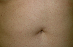 Caso 1: Lesiones típicas de liquen nitidus (pápulas pequeñas carnosas en el abdomen) antes del tratamiento.