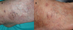 A) Múltiples pápulas violáceas en el dorso del pie derecho, previo tratamiento con imiquimod. B) Imagen clínica de remisión completa tras 10 semanas de tratamiento.
