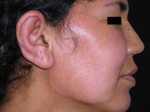 Placa eritemato-edematosa en la mejilla derecha y afectación del pabellón auricular.