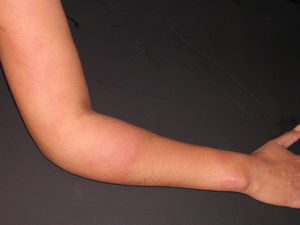 Lesión similar, con borde neto afectando el brazo y el antebrazo derechos.