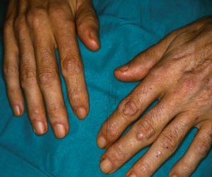 Nódulos en el dorso de ambas manos, que predominan en las áreas periarticulares.