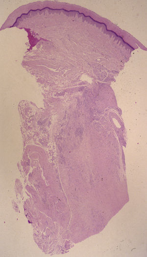 Granuloma necrobiótico en empalizada en la dermis media y profunda (hematoxilina-eosina ×40).