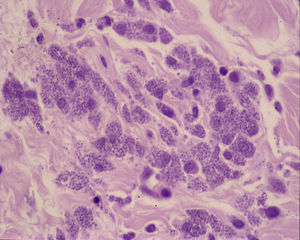 Un detalle: organismos de Leishmania dentro del citoplasma de los histiocitos (hematoxilina-eosina ×200).