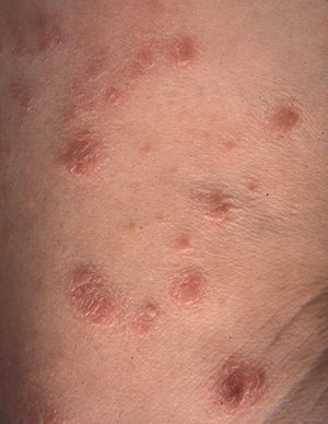Lesiones múltiples, papuloescamosas de papulosis linfomatoide.