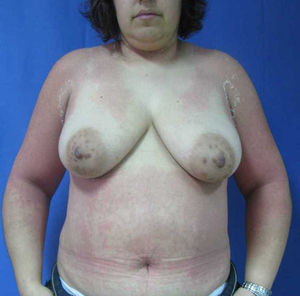 Exantema maculopapuloso en el tronco, que respeta el área del sostén.