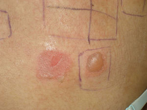 Positividad de pruebas epicutáneas (96h) al producto propio (anverso y envés).