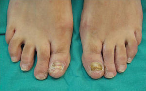 Lesiones eritemato-descamativas en los primeros dedos de ambos pies.