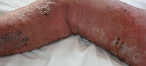 Placa eritemato-edematosa con formación de ampollas, erosiones y equimosis en la extremidad inferior derecha.