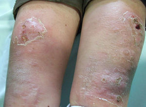 Lesiones nodulares bilaterales en la región posterior de las piernas, ulceradas, que drenan un material blanquecino.