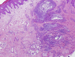 Infiltrado inflamatorio en la dermis papilar y reticular con depósitos de material amorfo. (Hematoxilina-eosina ×10).