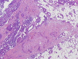 Material eosinófilo, amorfo y acelular en la hipodermis, rodeado por un infiltrado inflamatorio de linfocitos, macrófagos y células gigantes. (Hematoxilina-eosina ×25).