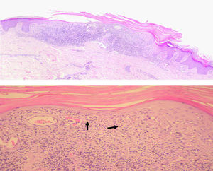Hiperqueratosis e infiltrado liquenoide en la dermis. Los hematíes extravasados se señalan con flechas. (Hematoxilina-eosina ×50, ×100).