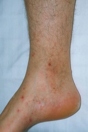 Mínimas lesiones purpúricas en las piernas, sugestivas de vasculitis séptica.