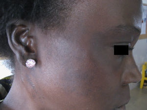 Hiperpigmentación periocular y ocronosis exógena en relación con el uso de hidroquinona en cremas despigmentantes (diagnóstico clínico).