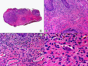Histopatología de una lesión genital por citomegalovirus que muestra las típicas inclusiones en las células endoteliales. (Hematoxilina-eosina, A x10, B x40, C x200, D x400).
