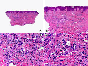 Histopatología de una lesión en parche de sarcoma de Kaposi que muestra células fusiformes disecando los haces de colágeno de la dermis. (Hematoxilina-eosina, A x10, B x40, C x200, D x400).