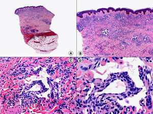 Histopatología de una lesión en placa de sarcoma de Kaposi que muestra el «signo del promontorio». Destaca la presencia de alguna célula plasmática en el infiltrado. (Hematoxilina-eosina, A x10, B x40, C x200, D x400).