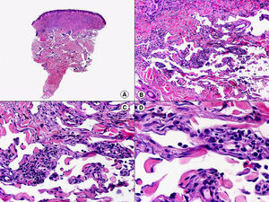 Histopatología de la denominada variante «linfangiomatosa» de sarcoma de Kaposi que muestra vasos irregulares de apariencia linfática disecando los haces de colágeno de la dermis reticular. (Hematoxilina-eosina, A x10, B x40, C x200, D x400).
