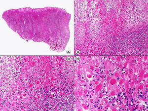 Histopatología de una lesión de orf que muestra abundantes cuerpos de inclusión eosinófilos en las células del epitelio epidérmico. (Hematoxilina-eosina, A x10, B x40, C x200, D x400).