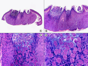 Histopatología del molusco contagioso que muestra los típicos cuerpos de inclusión. (Hematoxilina-eosina, A x10, B x40, C x200, D x400).