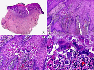 Histopatología de un herpes simple genital que muestra hallazgos similares a los de la figura anterior. (Hematoxilina-eosina, A x10, B x40, C x200, D x400).