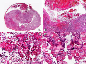 Histopatología de un seudolinfoma asociado a un molusco contagioso. Se observan los típicos cuerpos de inclusión. (Hematoxilina-eosina, A x10, B x40, C x200, D x400).