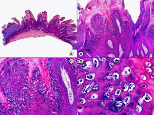 Histopatología de una verruga vulgar que muestra papilomatosis y coilocitos. (Hematoxilina-eosina, A x10, B x40, C x200, D x400).