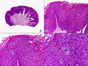 Histopatología de una lesión de papulosis bowenoide que muestra hallazgos de atipia y displasia intraepidérmica más focales que los de la enfermedad de Bowen, sin afectar a todo el espesor de la epidermis. (Hematoxilina-eosina, A x10, B x40, C x200, D x400).