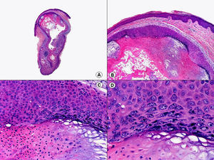 Histopatología de un quiste verrugoso que muestra una pared epitelial con un borde luminal papilomatoso, con acantosis en la que destaca la hipergranulosis con gránulos de queratohialina toscos, gruesos y de morfología irregular. (Hematoxilina-eosina, A x10, B x40, C x200, D x400).