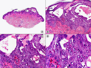 Histopatología de una varicela que muestra hallazgos indistinguibles a los que se observan en el herpes simple labial o genital. (Hematoxilina-eosina, A x10, B x40, C x200, D x400).