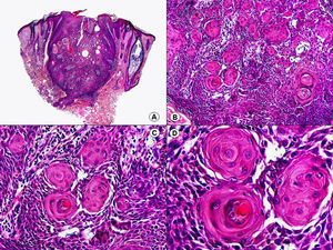 Histopatología de una queratosis folicular invertida que muestra una lesión endofítica con la arquitectura general de una verruga vulgar y la presencia de abundantes remolinos escamosos salpicando un epitelio escamoso. (Hematoxilina-eosina, A x10, B x40, C x200, D x400).
