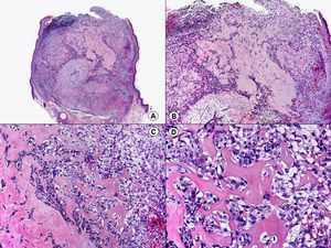 Histopatología de un tricolemoma desmoplásico que muestra una configuración general similar a la del tricolemoma clásico, pero en algunas áreas, particularmente en las áreas profundas de la lesión, los lóbulos epiteliales se continúan con cordones epiteliales de células pálidas o basaloides que se entremezclan con un estroma desmoplásico y con haces de colágeno esclerótico. (Hematoxilina-eosina, A x10, B x40, C x200, D x400).
