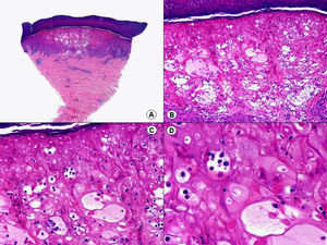 Histopatología de una lesión del síndrome mano-pie-boca que muestra vesiculación intraepidérmica con una llamativa balonización de los queratinocitos de las capas altas. (Hematoxilina-eosina, A x10, B x40, C x200, D x400).