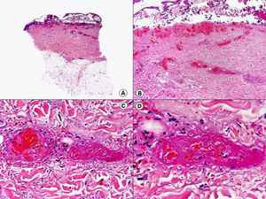 Histopatología de un herpes zóster que muestra una vasculitis leucocitoclástica en la dermis subyacente a la ampolla intraepidérmica. (Hematoxilina-eosina, A x10, B x40, C x200, D x 400).
