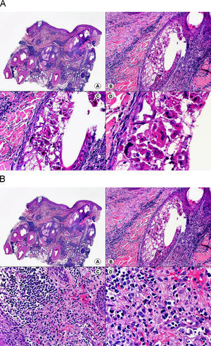 Histopatología de un seudolinfoma desarrollado sobre una lesión de un herpes zóster. A) El epitelio del folículo piloso y la glándula sebácea muestran los cambios citopáticos típicos de infección herpética. B) Abundan los linfocitos atípicos y las figuras de mitosis en el infiltrado alrededor de la lesión. (Hematoxilina-eosina, A x10, B x40, C x200, D x400).