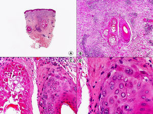Histopatología de una lesión reciente de herpes zóster que muestra los cambios citopáticos típicos en el epitelio del folículo piloso y sin afectación epidérmica. (Hematoxilina-eosina, A x10, B x40, C x200, D x400).