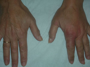Placa eritematosa que abarca el dorso de los dedos y la articulación metacarpofalángica.