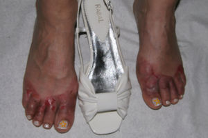 Aspecto clínico en los pacientes adultos. Dermatitis de contacto aguda grave. Presencia de ampollas en el dorso de los dedos de ambos pies que afecta a toda la superficie cutánea en contacto con el calzado nuevo.