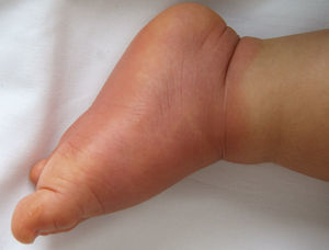 Aspecto clínico en los pacientes infantiles. Angioedema de contacto que afecta tanto a la planta como al dorso del pie y que dibuja el borde del calzado implicado.