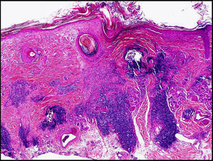 Corte histológico en el que se aprecia un infiltrado perianexial linfocitario, con dermatitis de interfase en la capa basal (hematoxilina-eosina, ×20).