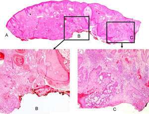 A) Sección completa de piel que muestra la pared del quiste malignizado en el borde profundo, y el trayecto fistuloso en el centro. No se ve contacto del tumor con la epidermis (hematoxilina-eosina [H-E]). B), C) Carcinoma epidermoide creciendo en la pared del quiste en contacto con el borde quirúrgico profundo (H-E 2,5×).