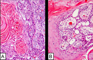 Carcinoma epidermoide. A) patrón convencional (detalle de la fig. 1B). B) patrón adenoide (detalle de la fig. 1C) (hematoxilina-eosina 10×).