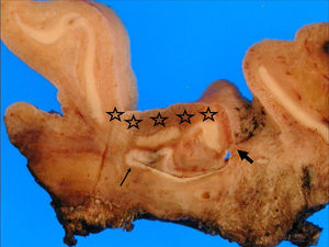 Amputación del pabellón auricular. Estrellas: cartílago interrumpido como consecuencia de las cirugías previas; flecha fina: quiste; flecha gruesa: fístula.