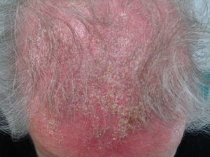 Placa eritematosa con descamación y presencia de costras melicéricas en el cuero cabelludo.