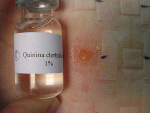 Prueba epicutánea (++++) al clorhidrato de quinina al 1% a las 48h.