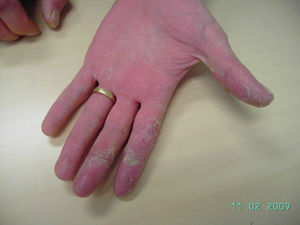 Lesiones de dermatitis de contacto por acrilatos.