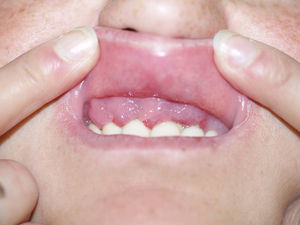 Hiperplasia gingival marcada en la arcada superior dentaria. Erosiones de los labios y las encías.
