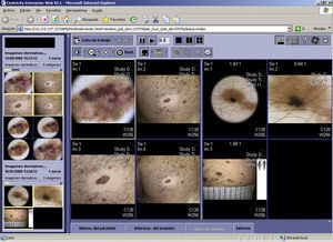 Recuperación de imágenes dermatológicas del Picture Archiving and Communication Systems de un mismo paciente en diferentes momentos a través de Centricity Web.